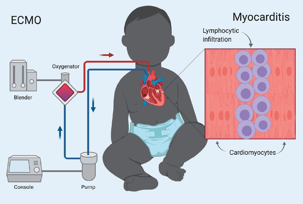 Myocarditis