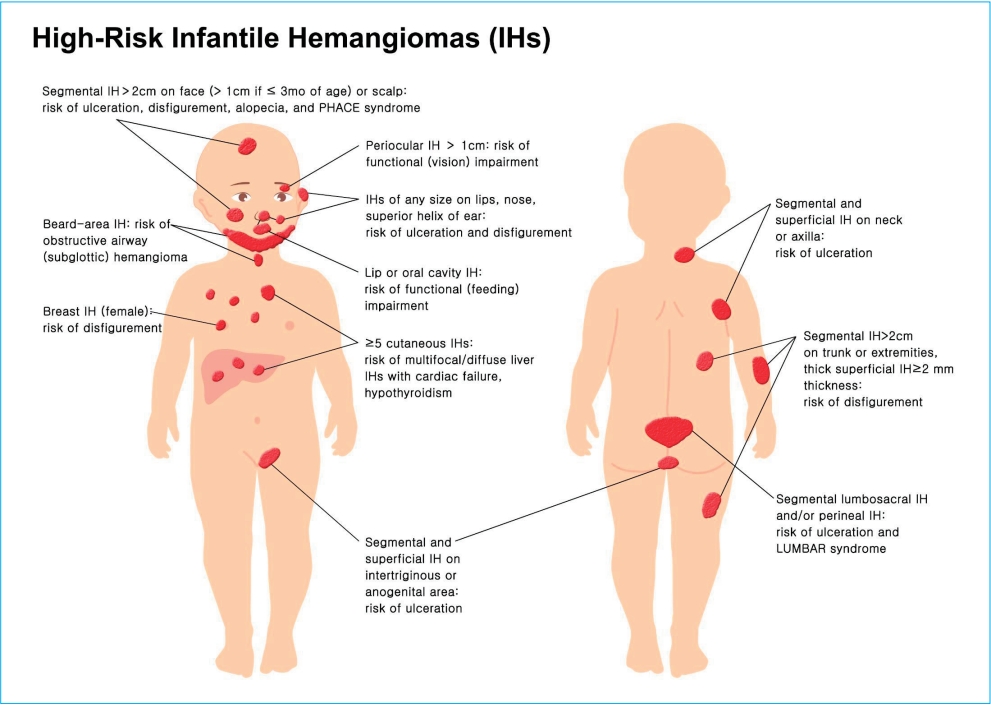 Hemangioma