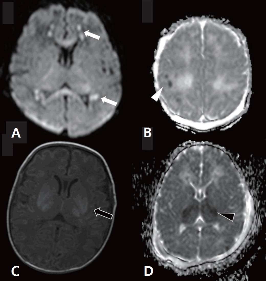 Characteristics and short-term outcomes of neonates with mild hypoxic-ischemic  encephalopathy treated with hypothermia