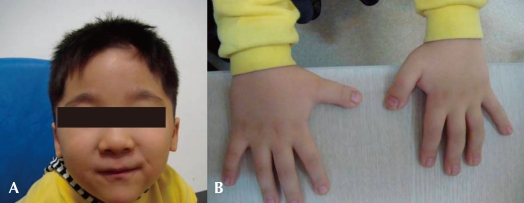 A Case of Rubinstein-Taybi Syndrome with Tetralogy of Fallot