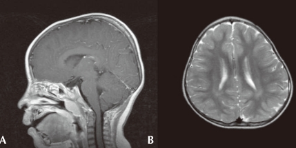 Rubinstein-Taybi syndrome with agenesis of corpus callosum